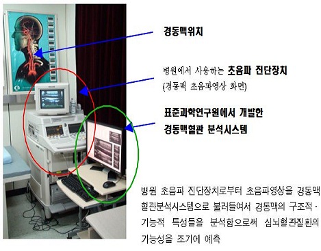 간단한 목 초음파검사로 심장병 뇌졸중 위험 조기진단