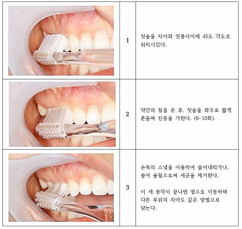 이 시린 치주질환, 올바른 칫솔질로 예방