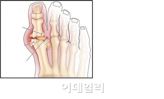 스치는 바람에 통증 호소하는 통풍