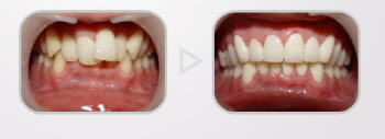 수능 끝나고 치아성형, 얼굴성형 하고 싶다면...