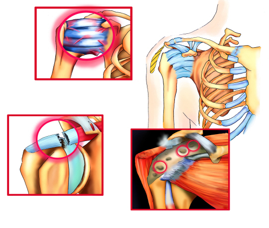  '석회성 힘줄염과 오십견', "골퍼에겐 치명적"