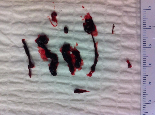 그물망 이용, "피떡으로 막힌 뇌혈관 90% 이상 뚫어"