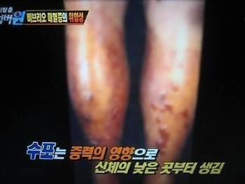 비브리오패혈증 증상, 심해지면 사망 가능성 ↑