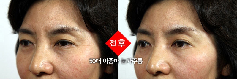안면 팔자 주름도 펴주는 ‘기적크림’ 등장