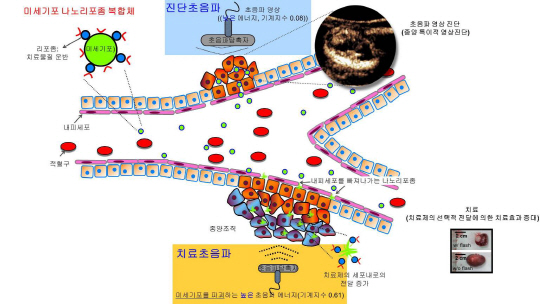"초음파 영상 유도하 치료법, 새로운 항암치료 기대"