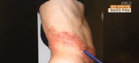 대상포진 예방법 관심, 초기대처 늦으면 '평생 신경통'