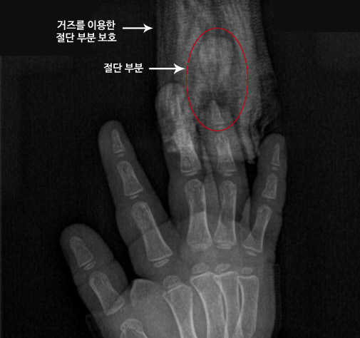 나들이 길, '부주의'가 어린이 손가락 절단사고의 원인