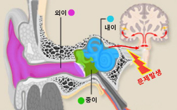 원인 불명 영유아 청각신경병증... 원인 찾고 와우이식술 결과도 예측