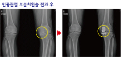 [아는 것이 힘] 인공관절 부분치환술, 연골 뼈.인대 보존...회복도 빨라