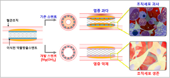 "심장질환, 차세대 염증억제 약물방출 스텐트로 해결한다"