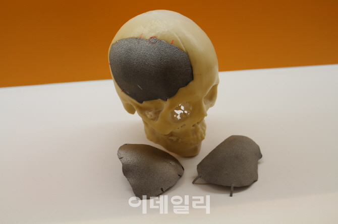 3D 프린터로 만든 두괴골, 이식 수술 했다