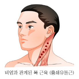 비염 등 인체 질환 근육과 관련 있어 '눈길'