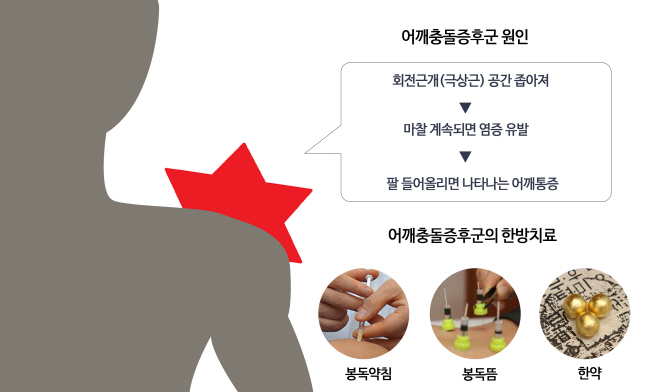 어혈로 기혈순환 막히면 어깨에서 ‘억’