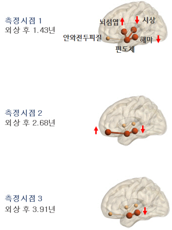 "대구지하철 참사 생존자 통해 외상후스트레스장애 치료 실마리 찾았다"