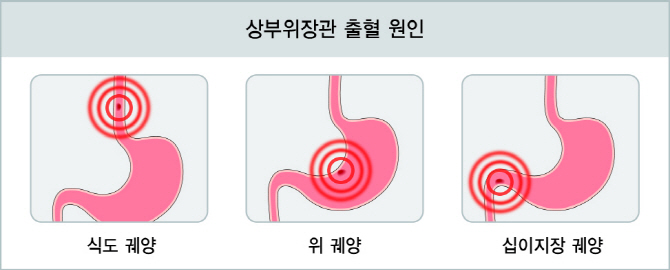 장 출혈 환자 5년 사이 30% 증가...빠른 지혈이 사망률 낮춰