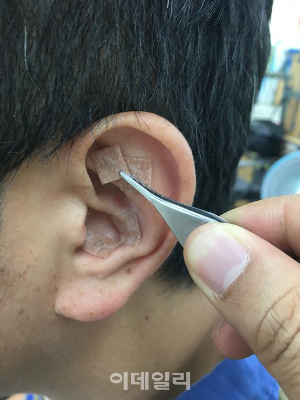 비만·금연치료 '피내침·'이침', ISO 국제표준으로 제정