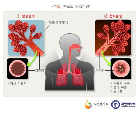 고령 천식 환자 겨울철 '빨간불'…"외출시 준비운동 마스크해야"