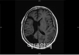 뇌전증 환자 1년만에 2000명 늘었다…20대 최다