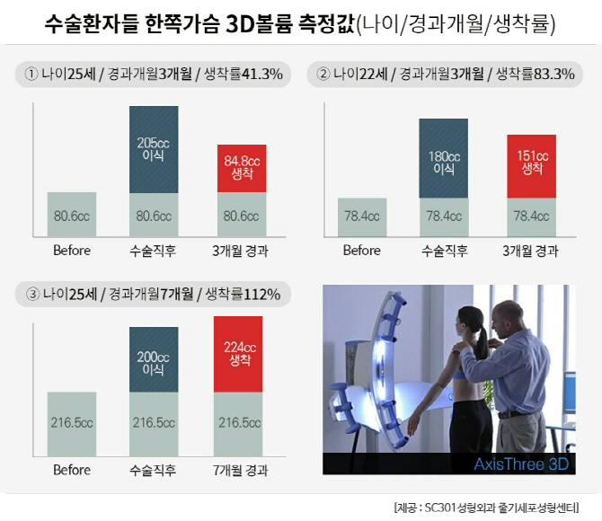 줄기세포 가슴성형, 3D볼륨값 측정으로 생착률 '미리 체크'