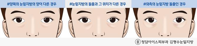 눈밑지방, 돌출 정도 및 위치에 따라 섬세한 시술 적용돼야 