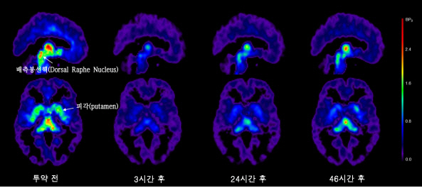 우울증·강박증 치료제 복용 후 나타나는 뇌 부위별 분포차이 확인
