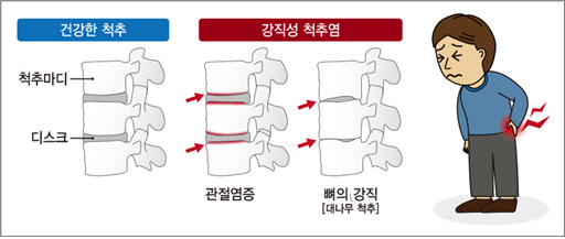 전신면역 질환인 강직성척추염... 단백뇨 검출되면 '의심'