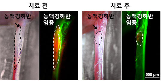 심근경색. 심장마비 일으키는 고위험 '동맥경화반' 표적치료제 개발