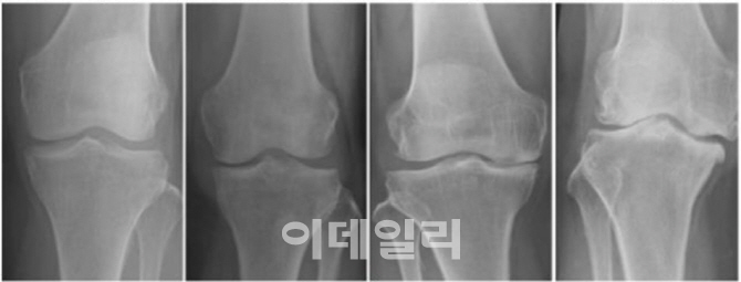 줄기세포·유전자치료제…옵션 넓어지는 퇴행성관절염 치료법