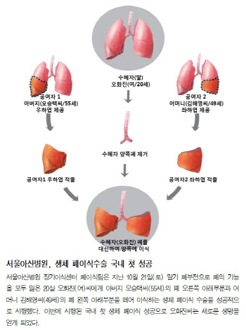 국내에서도 '생체 폐이식' 성공 ... 폐이식 대기자들에게 큰 희망