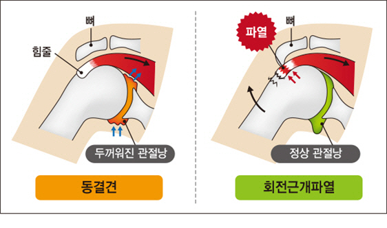 밤잠 설치는 어깨통증... 무관심이 병 키운 탓