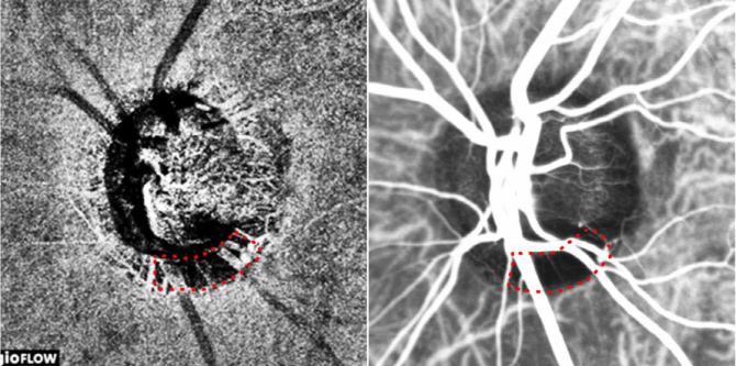녹내장 원인 ‘시신경 혈류 저하’, 비침습적 검사로 정확히 관찰