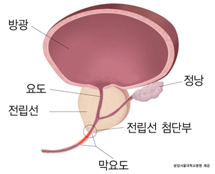 전립선암, 로봇 수술이 개복수술보다 치료 효과 우수