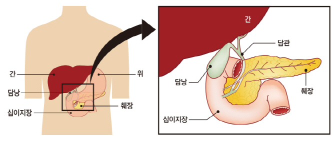 '담석' 생명까지 위협하는 몸속의 돌...콕콕 쑤시는 복통 지속되면 '의심'