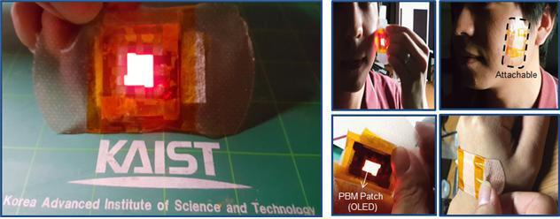 ‘피부에 부착하는 OLED로 상처치유’..병원 레이저 기기 대체 관심