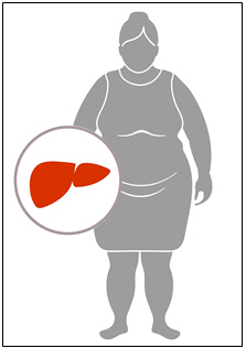 비만 만성 B형간염 환자, 간암 위험 높아 '주의'