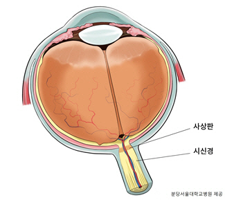 시력 잃어가는 녹내장…변형된 사상판, 발병 위험 높여