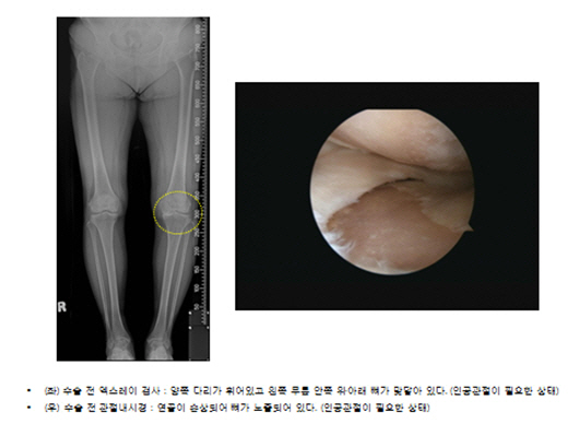 무릎 퇴행성관절염, 줄기세포 '재생치료'…수술 효과↑