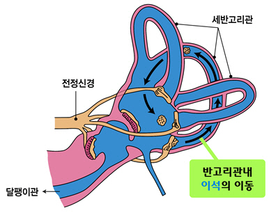 재발 잘하는 '이석증' ... 폐경 여성 더욱 조심해야