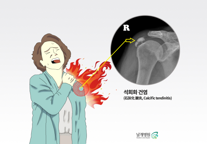 어깨 힘줄에 단단한 돌이 박혀 염증 생긴 '석회화건염'