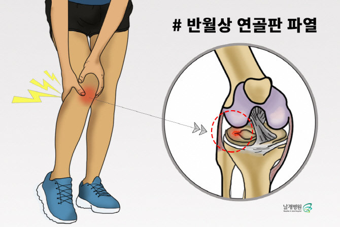 젊은 연령층에 흔한 무릎통증... '반월상 연골판' 손상 많아