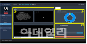 AI 기반 의료기기 허가 잇따라…‘루닛 인사이트·JBS-01K’ 승인