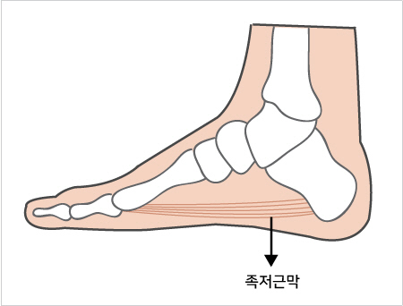 등산 다음날 발바닥 쑤신다면... '족저근막염' 의심