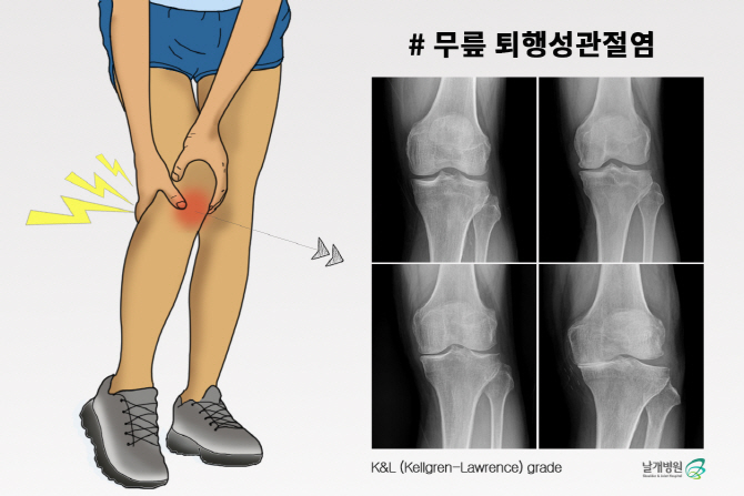 퇴행성관절염, 비수술적 치료로 회복 가능하다는데?