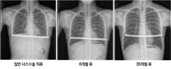 선천성 기형인 오목가슴...성장기에 교정해 주는 것이 좋아