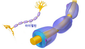 국내 의료진, 시신경염의 재발 원인 찾았다