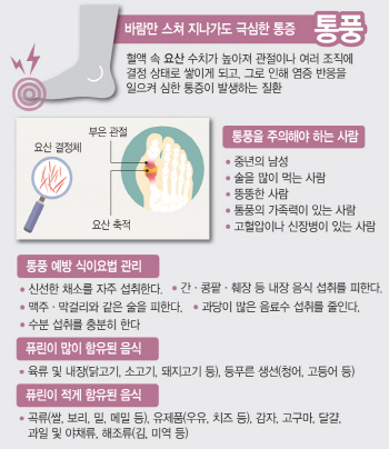 '통증의 왕' 통풍, 중년 남성들 주의보 ...맥주 소주 등 술은 피해야