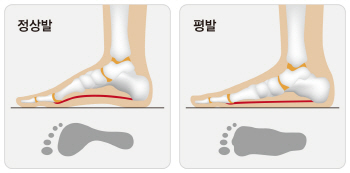 일상생활에 지장 초래하는 우리아이 '평발', 꼭 교정해야 하나