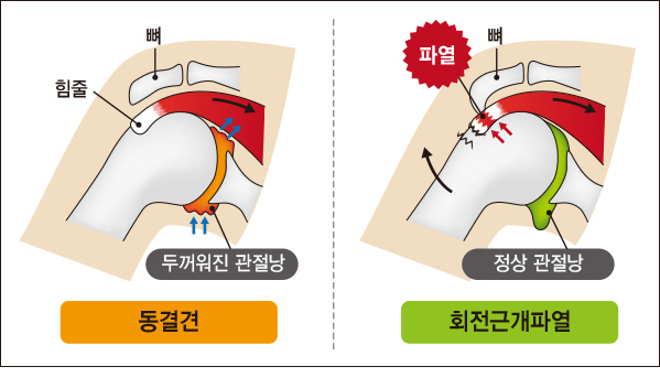 오십견·회전근개 파열·석회성 건염 원인도 다양한 어깨질환