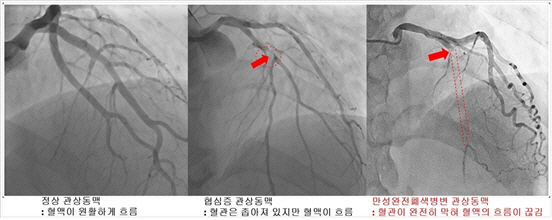 심장혈관 완전히 막혀도 약물로 치료 가능