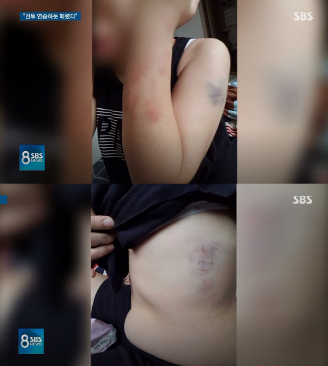 “남편이 샌드백 치듯 때렸다”…베트남 아내, 멍투성이 몸 공개